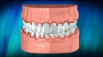 Dental teeth